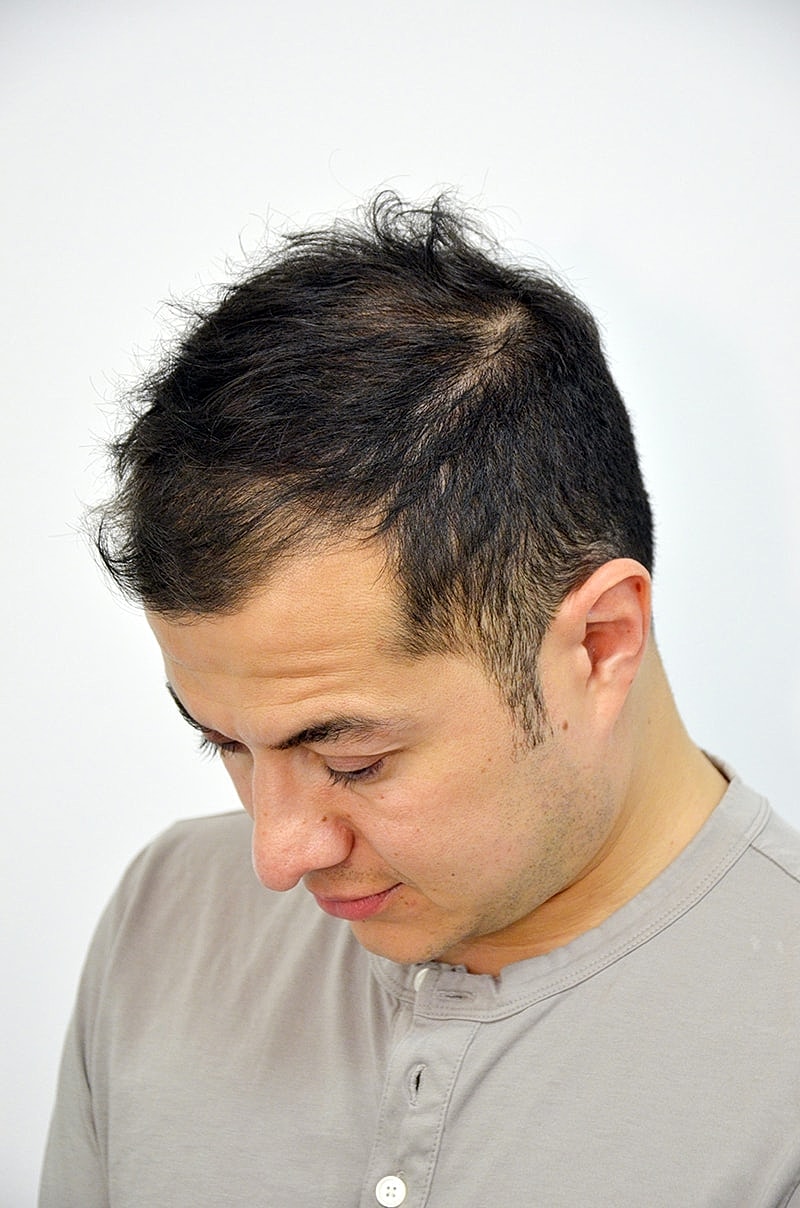 Hair Transplant Before & After