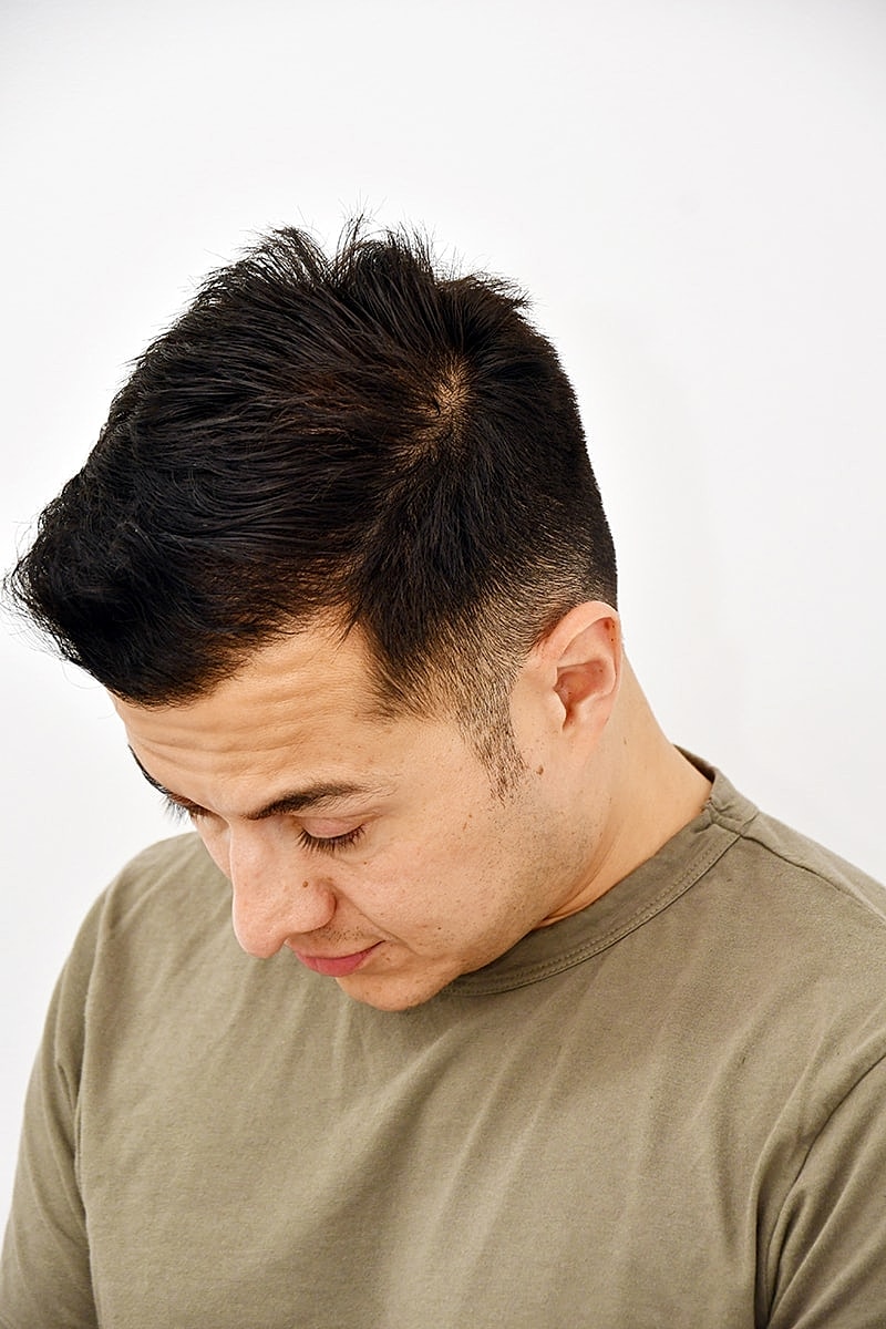 Hair Transplant Before & After