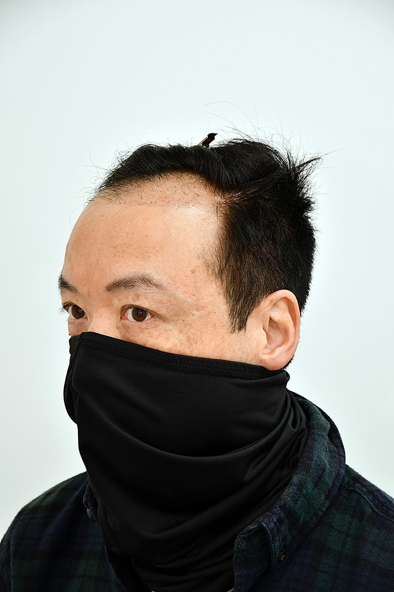 Hair Transplant Before & After