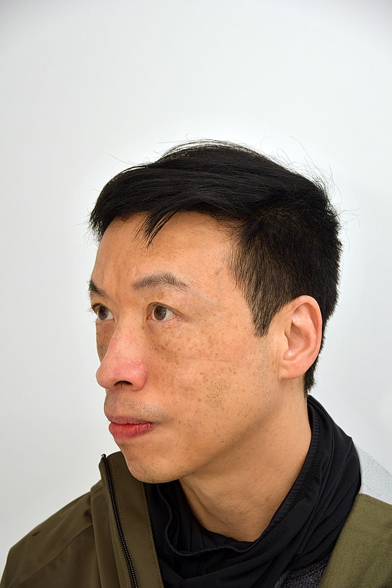 Hair Transplant Before & After