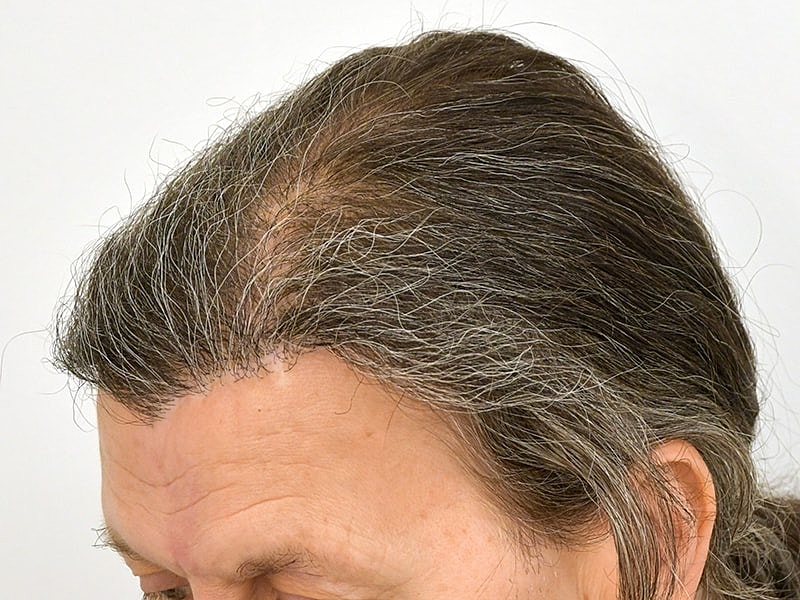 Hair Transplant Before & After