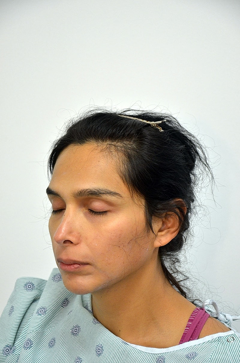 Hair Transplant Before & After