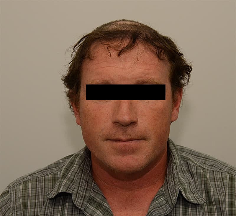 Hair Transplant Before & After