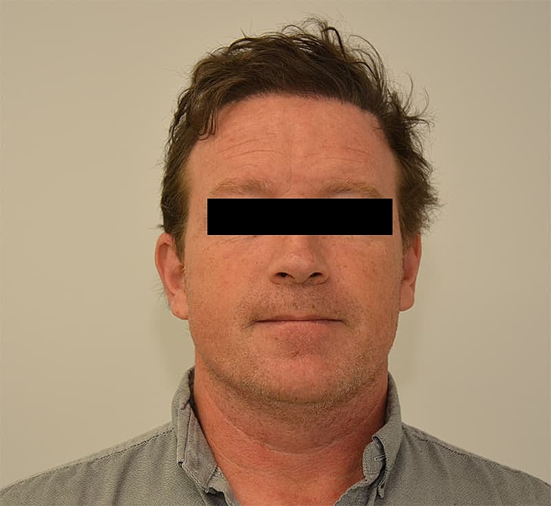 Hair Transplant Before & After