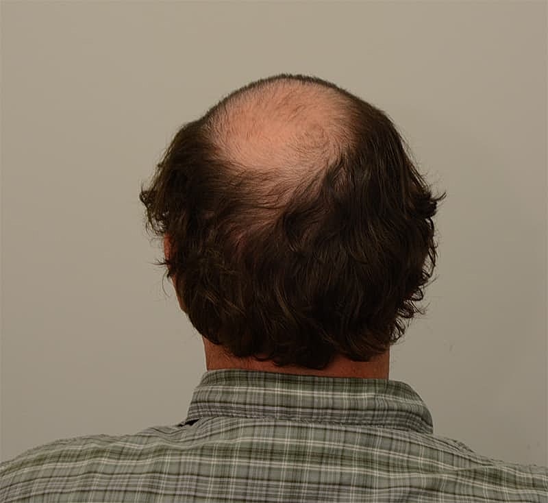 Hair Transplant Before & After