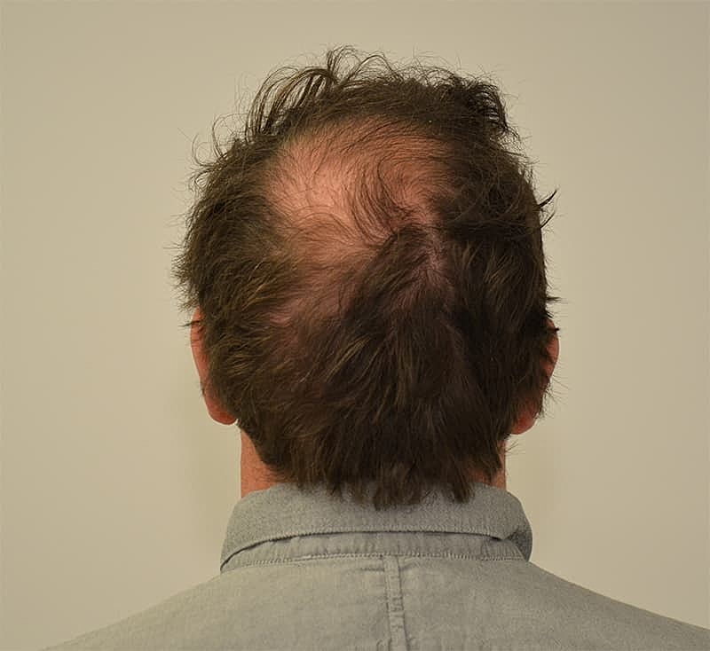 Hair Transplant Before & After