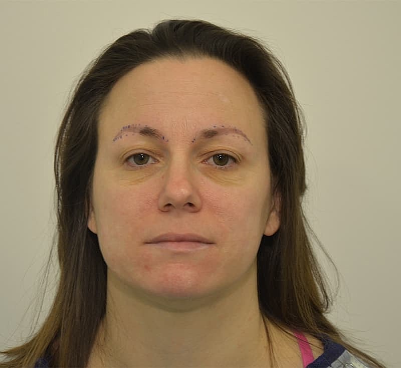 Hair Transplant Before & After