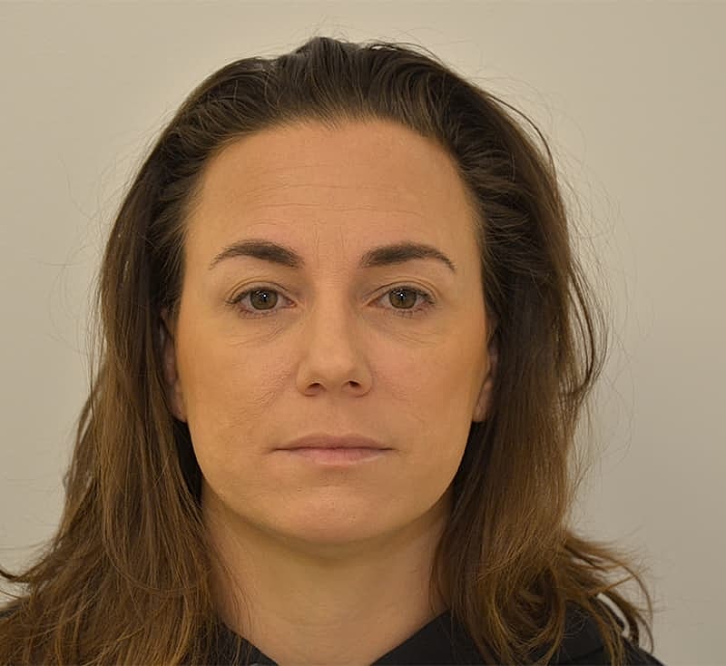 Hair Transplant Before & After