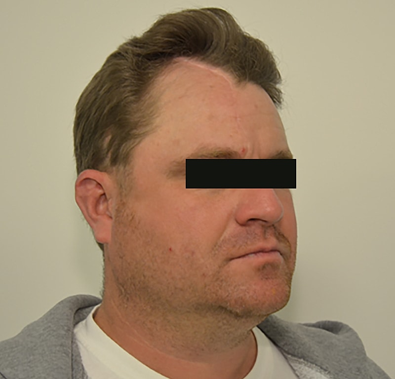 Hair Transplant Before & After