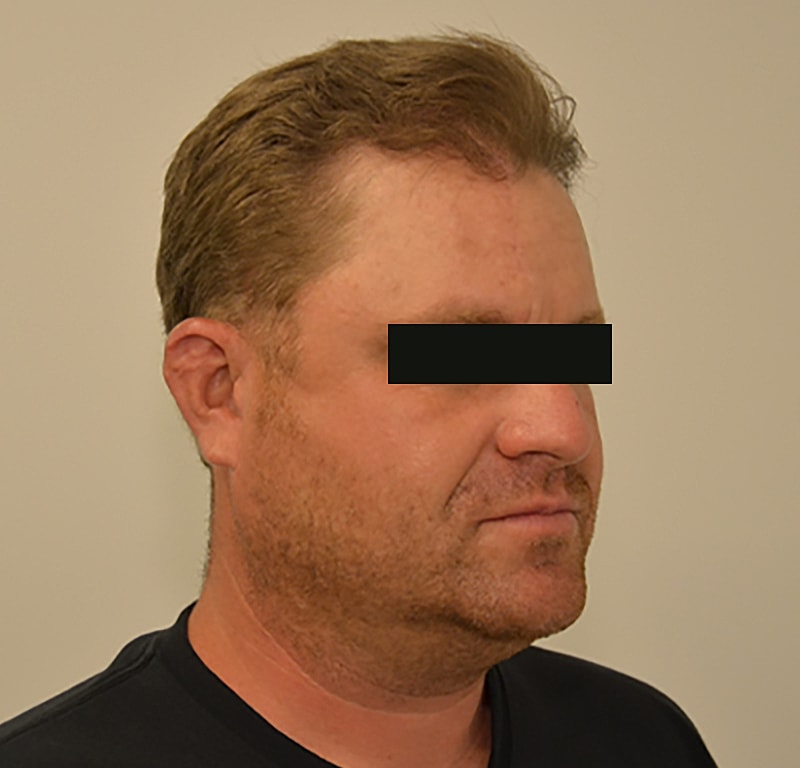 Hair Transplant Before & After