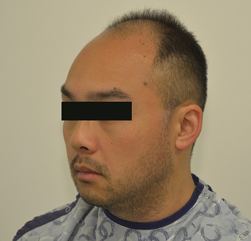 Hair Transplant Before & After