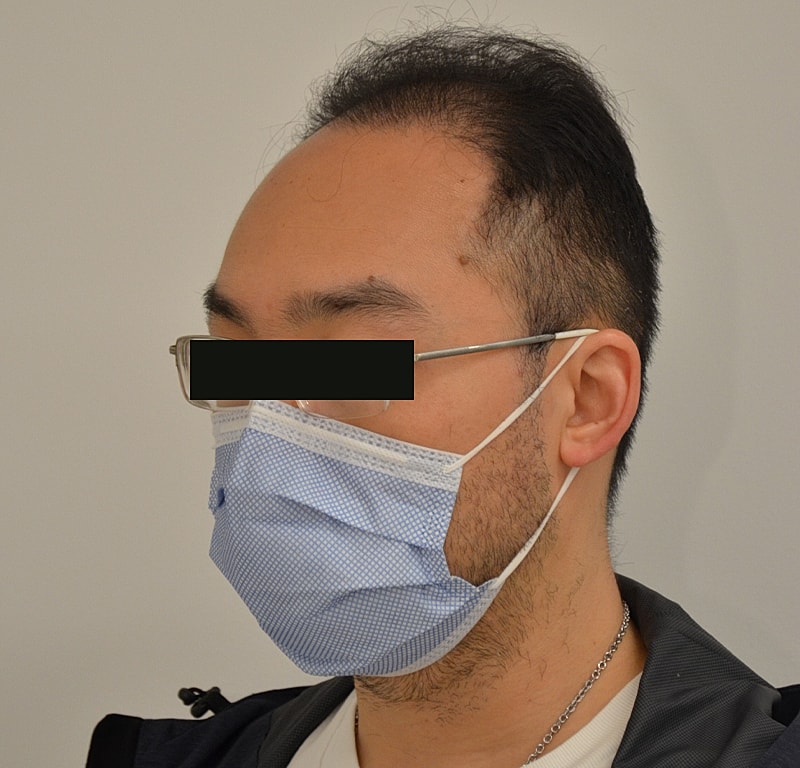 Hair Transplant Before & After