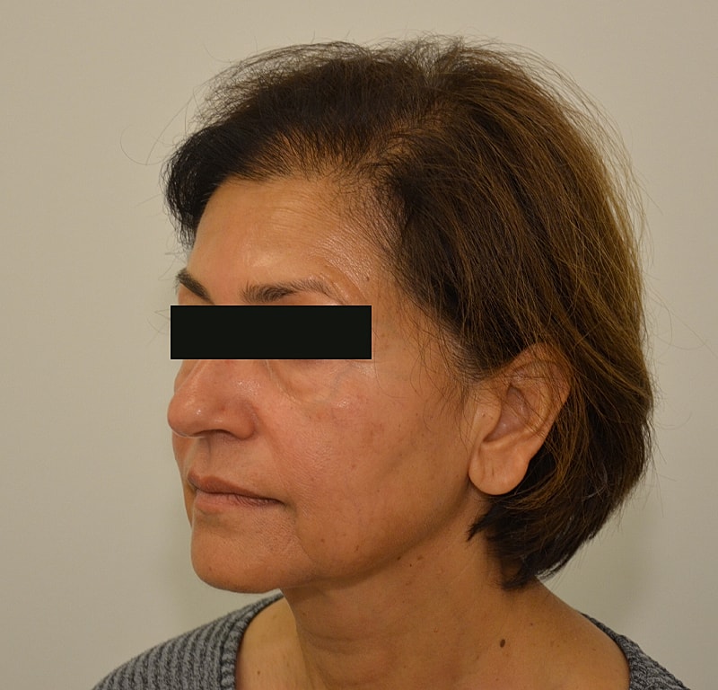 Hair Transplant Before & After