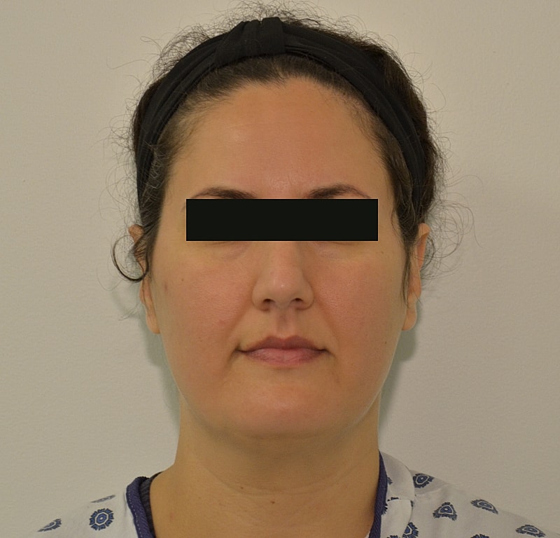 Hair Transplant Before & After