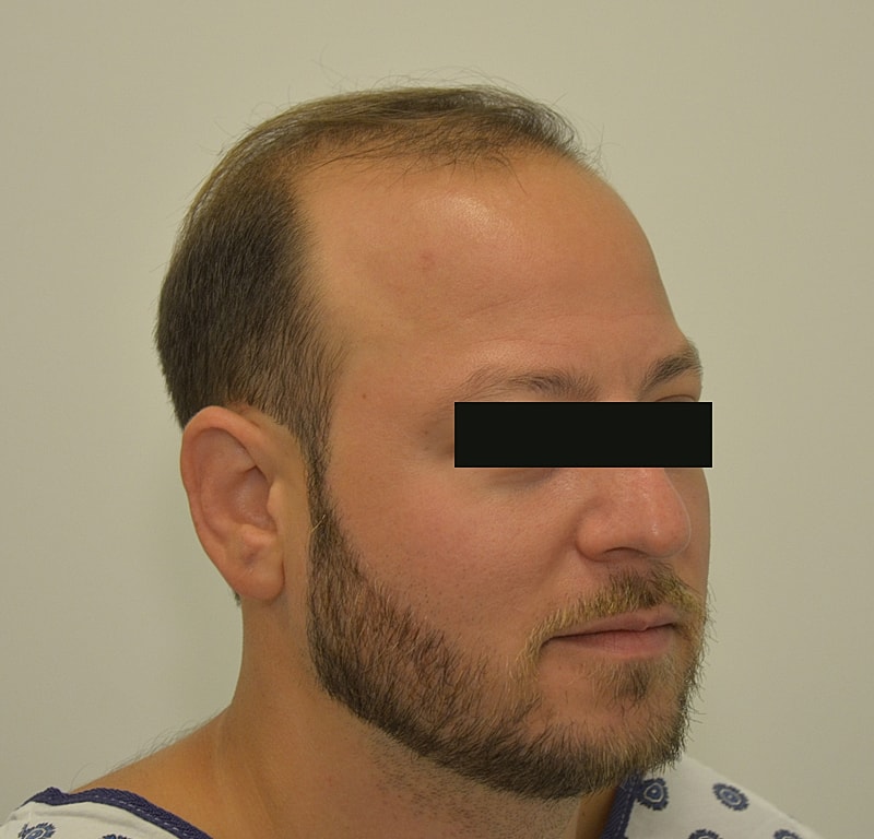 Hair Transplant Before & After