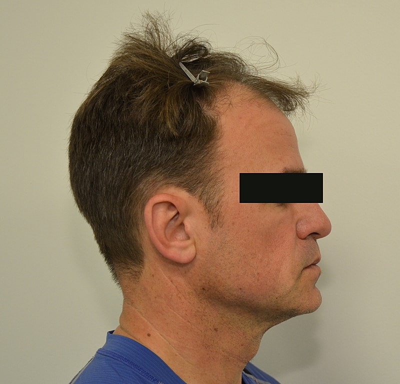 Hair Transplant Before & After