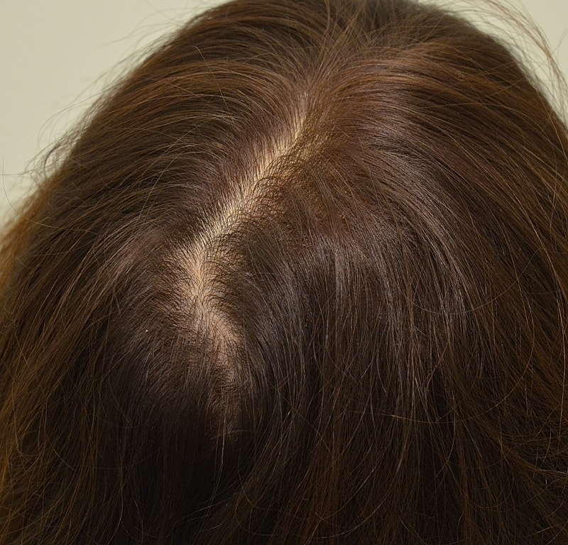 Hair Transplant Before & After