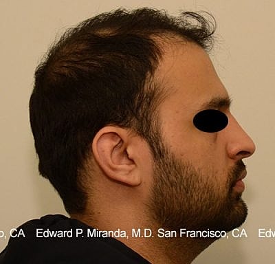 Hair Transplant Before & After