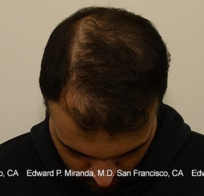 Hair Transplant Before & After