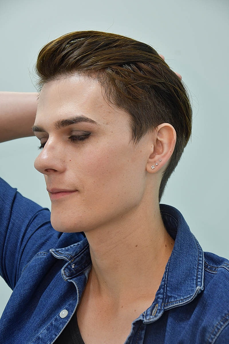 Hair Transplant Before & After