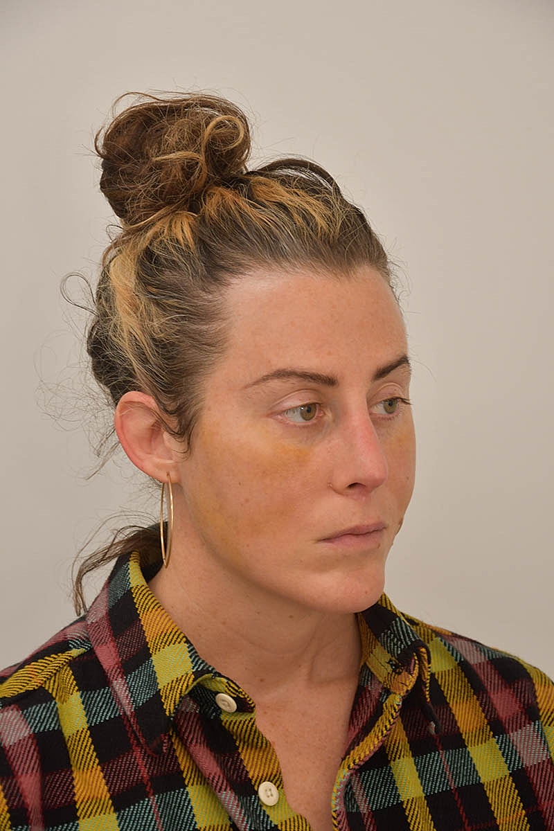 Hair Transplant Before & After