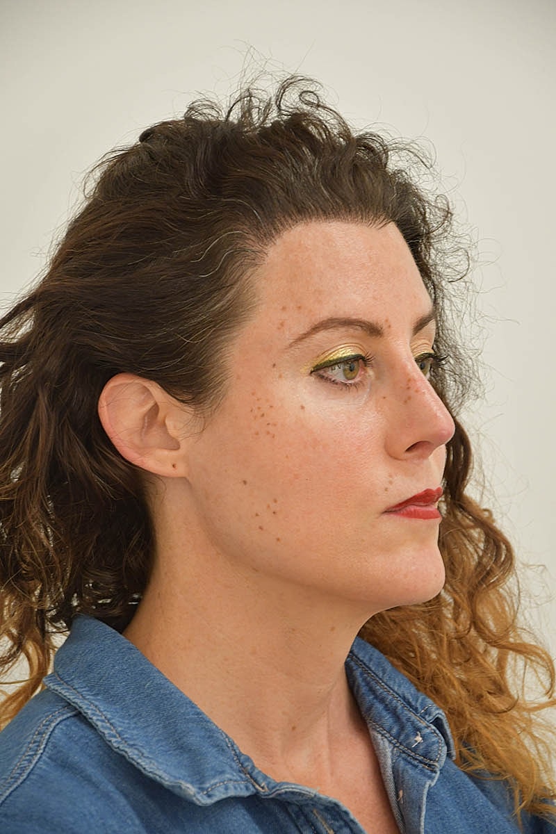 Hair Transplant Before & After