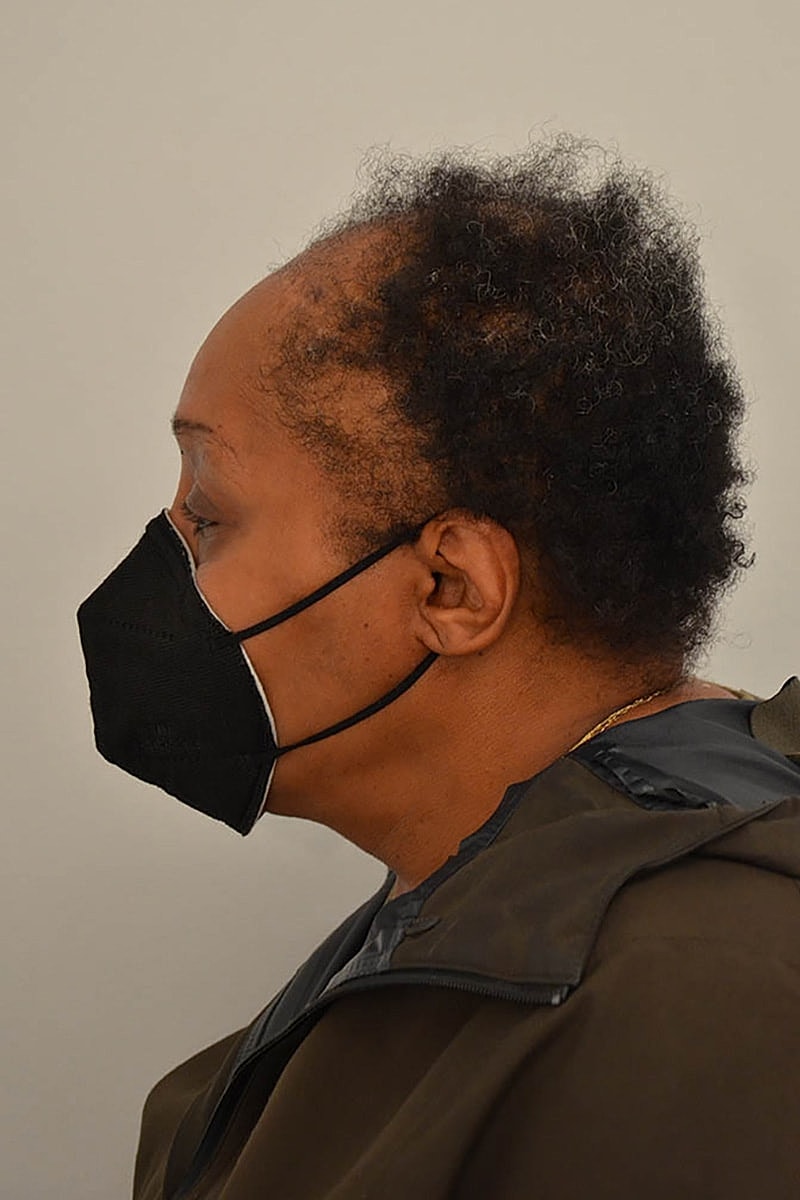 Hair Transplant Before & After