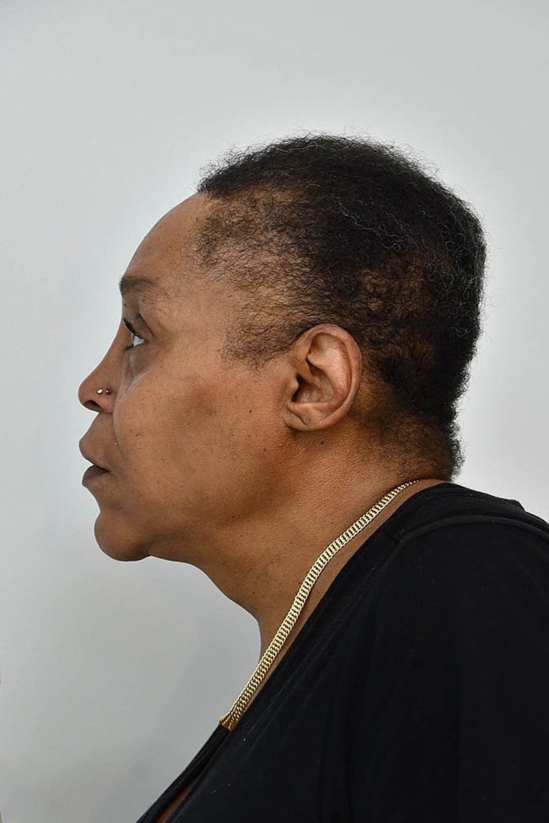 Hair Transplant Before & After