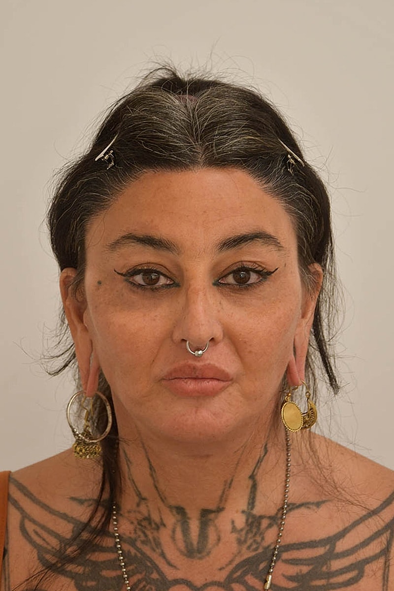 Hair Transplant Before & After