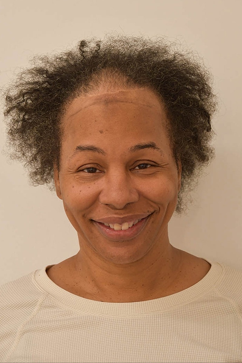 Hair Transplant Before & After