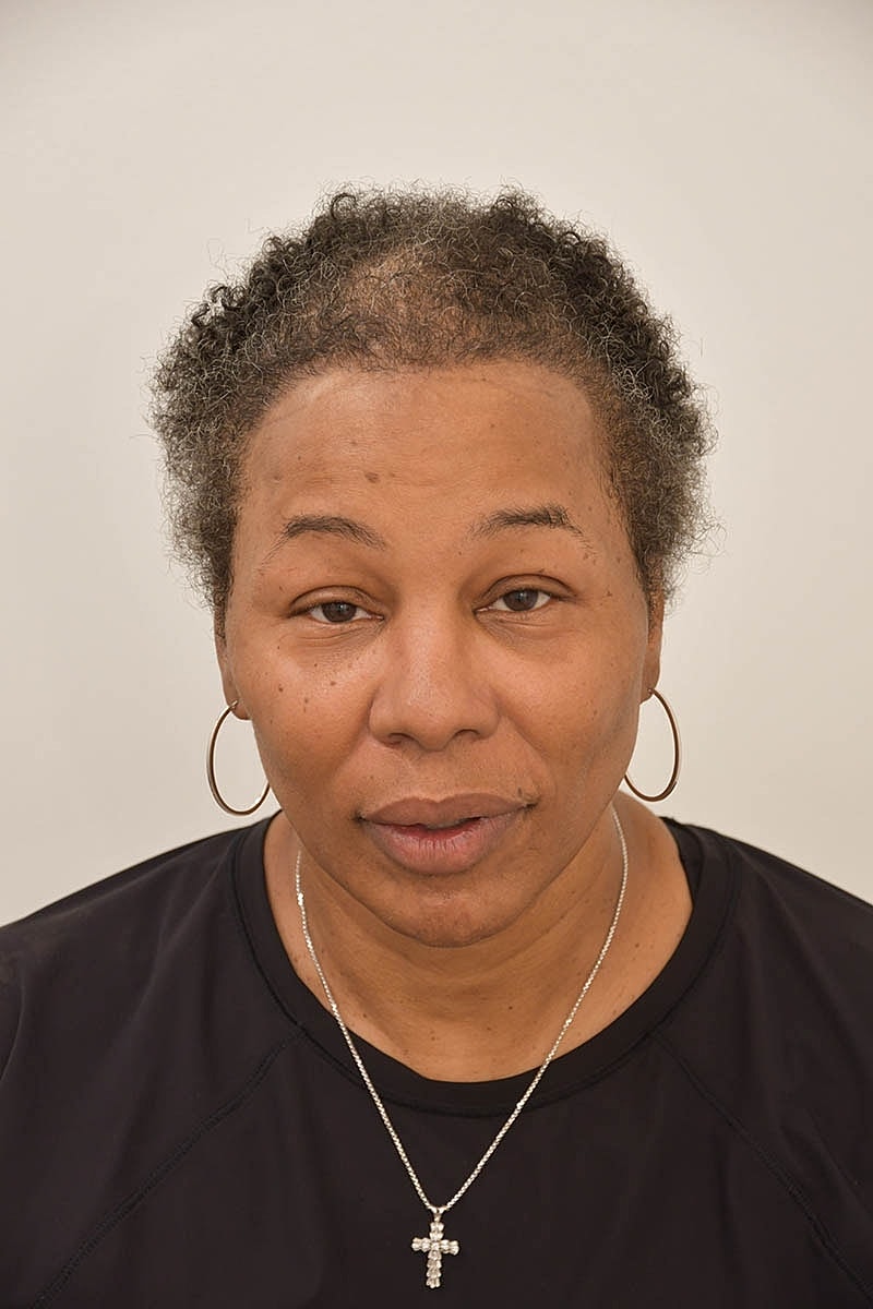 Hair Transplant Before & After