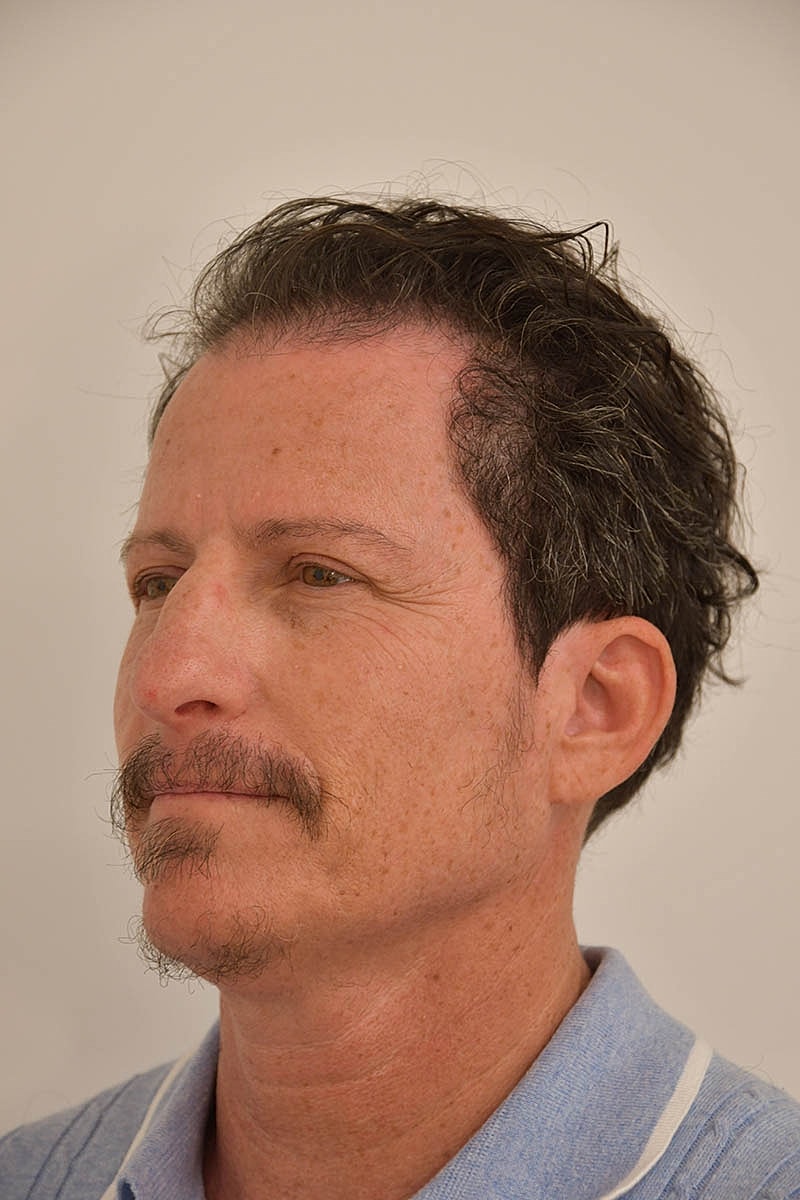 Hair Transplant Before & After