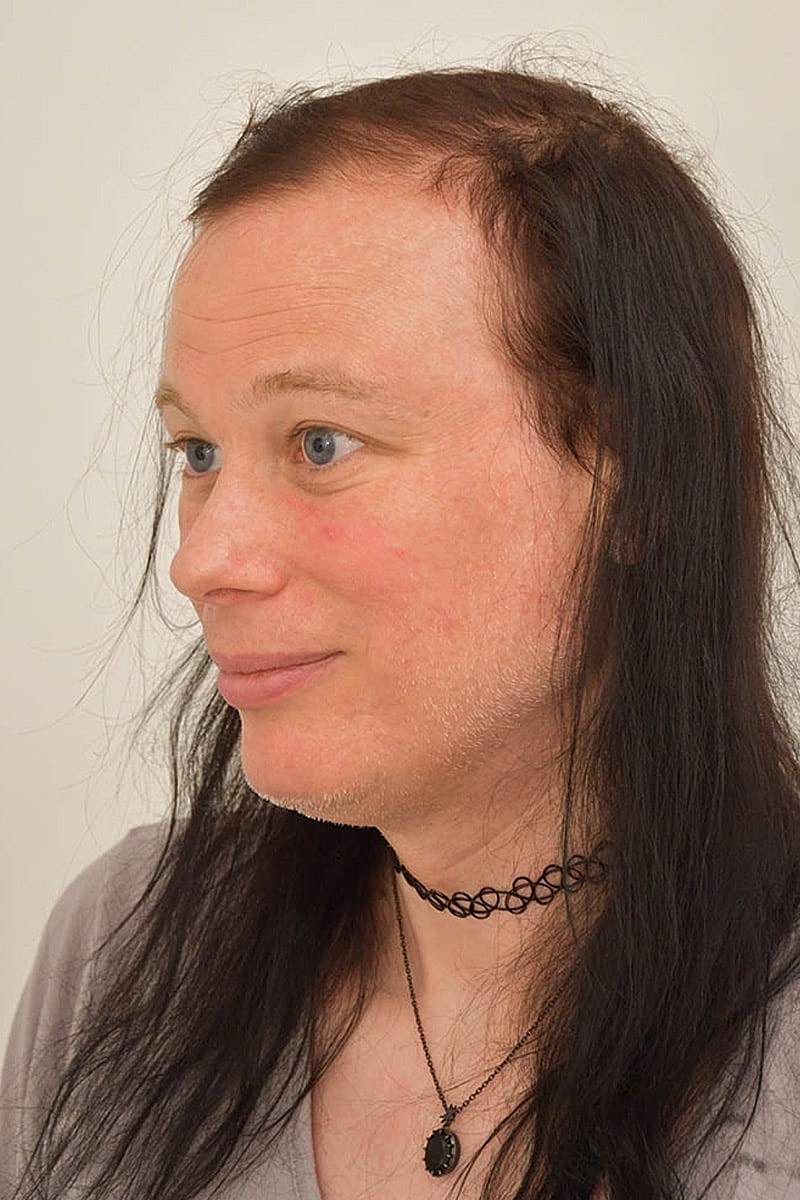 Hair Transplant Before & After