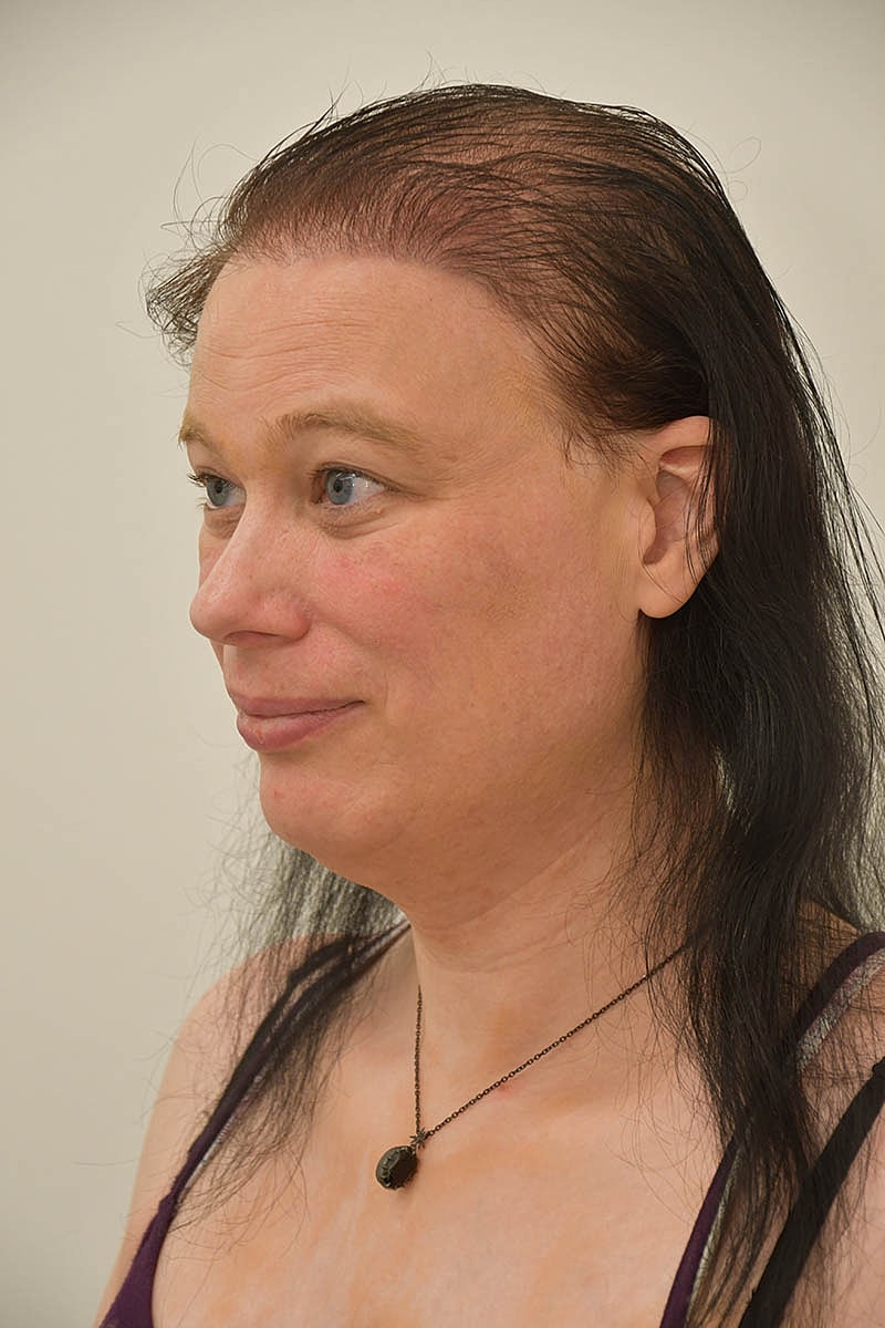 Hair Transplant Before & After