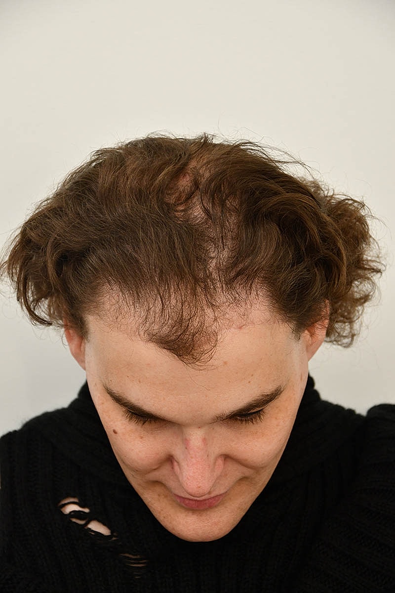 Hair Transplant Before & After