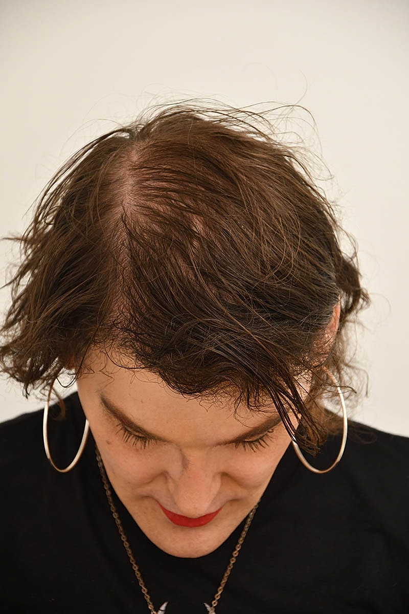 Hair Transplant Before & After