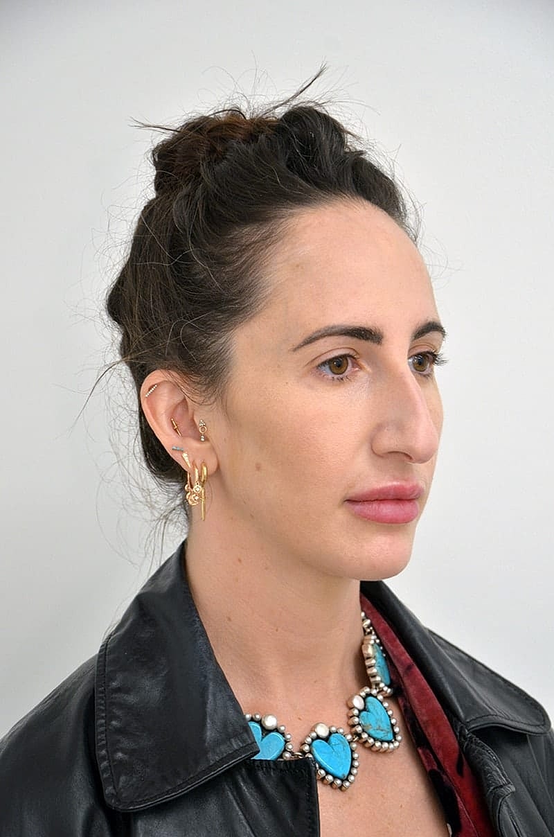 Hairline Lowering Before & After