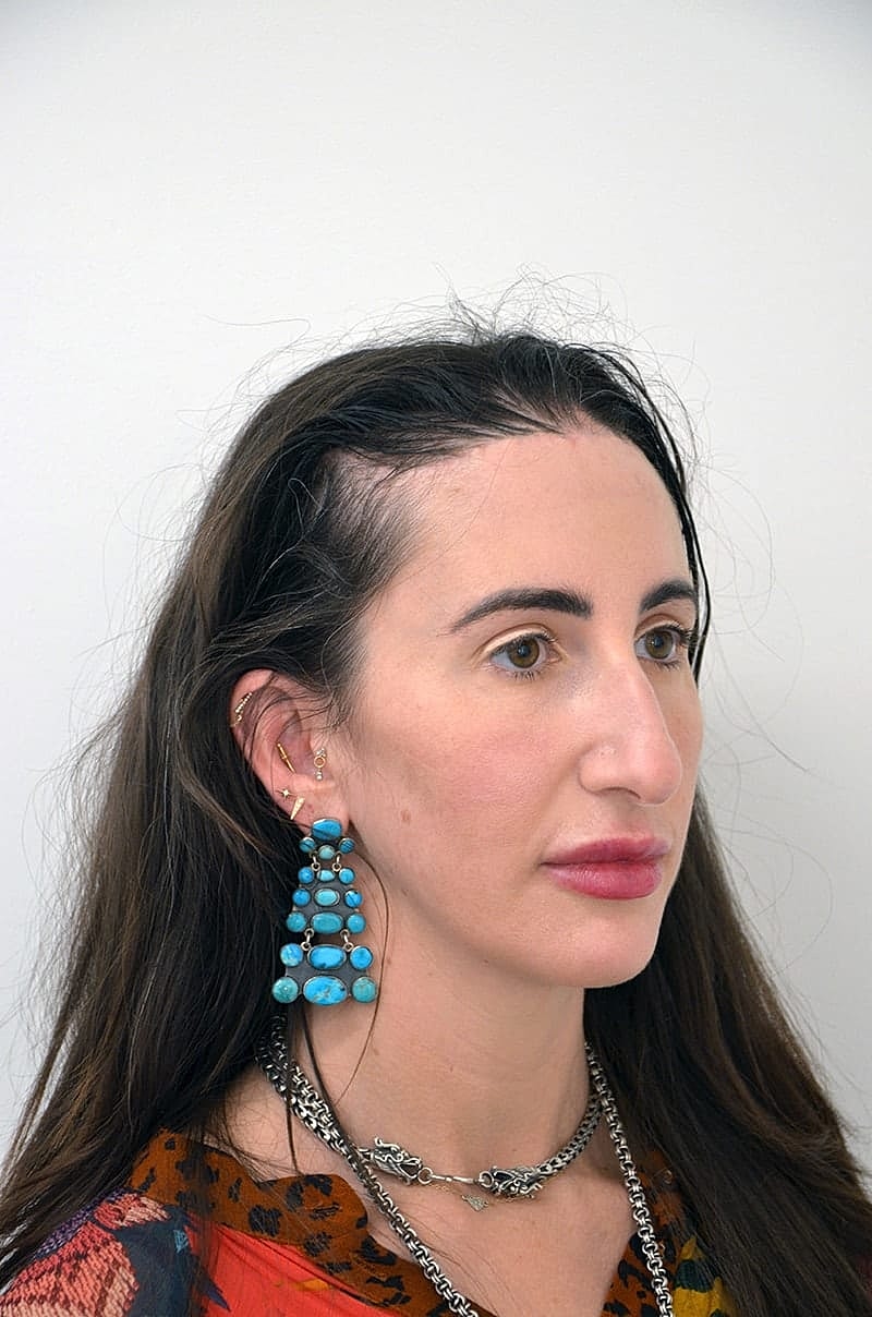 Hairline Lowering Before & After