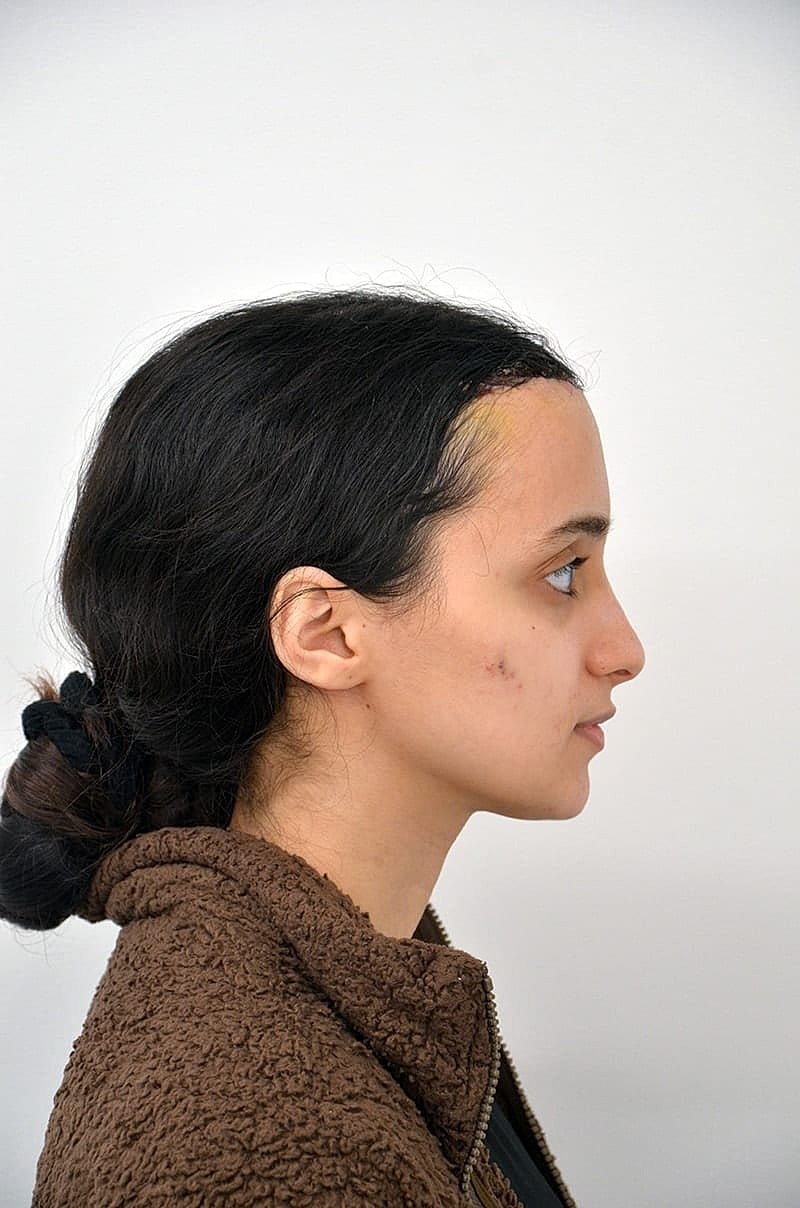 Hairline Lowering Before & After