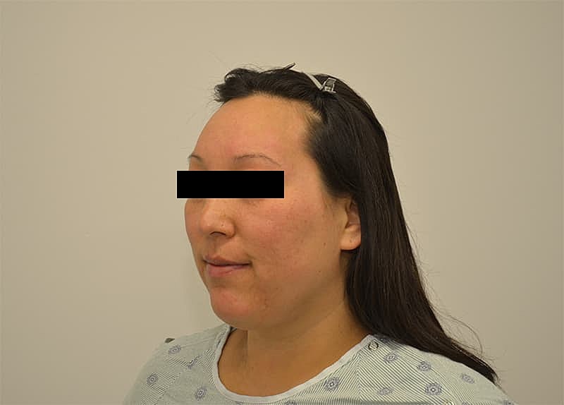 Hairline Lowering Before & After