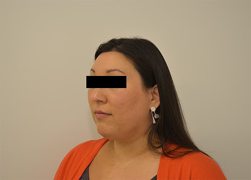 Hairline Lowering Before & After