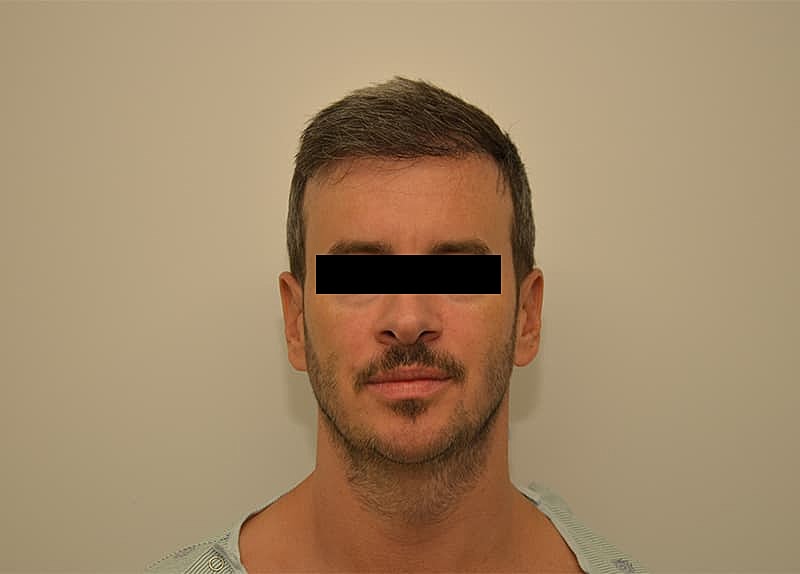 Hairline Lowering Before & After