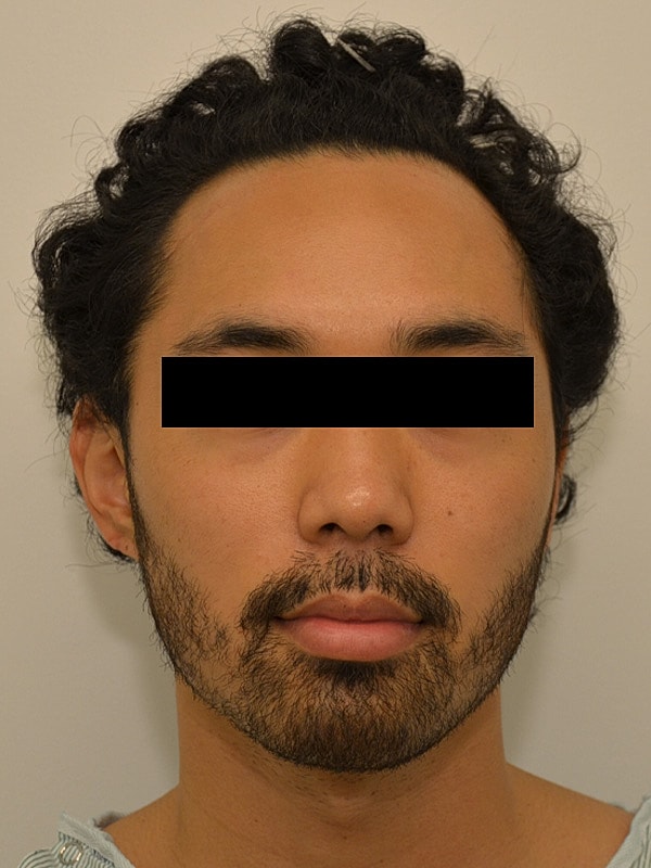 Hairline Lowering Before & After