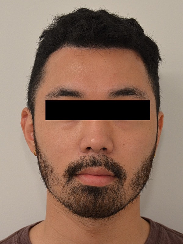 Hairline Lowering Before & After