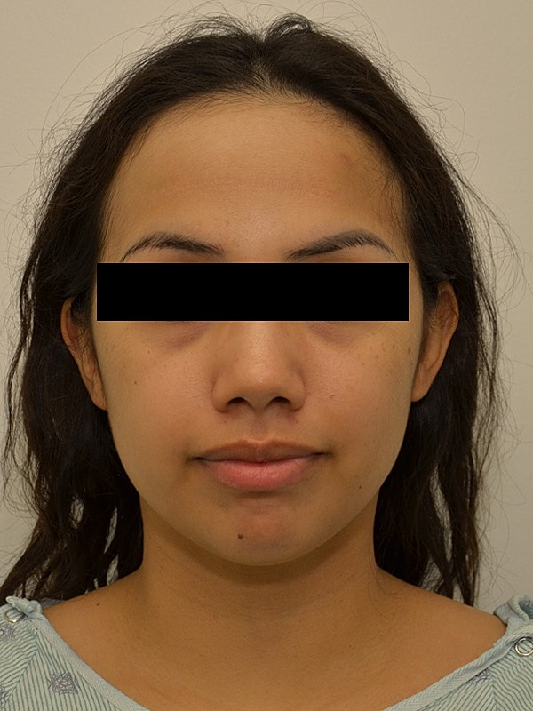 Hairline Lowering Before & After