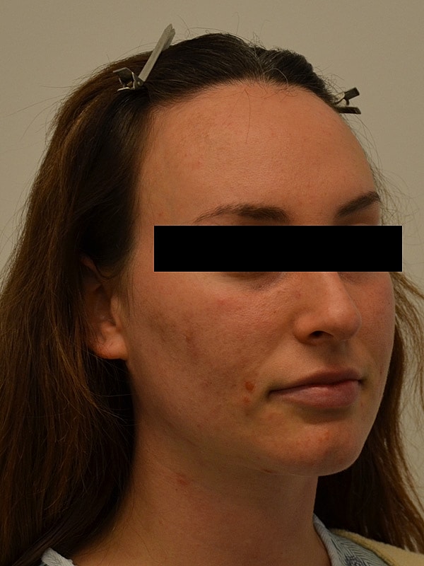 Hairline Lowering Before & After