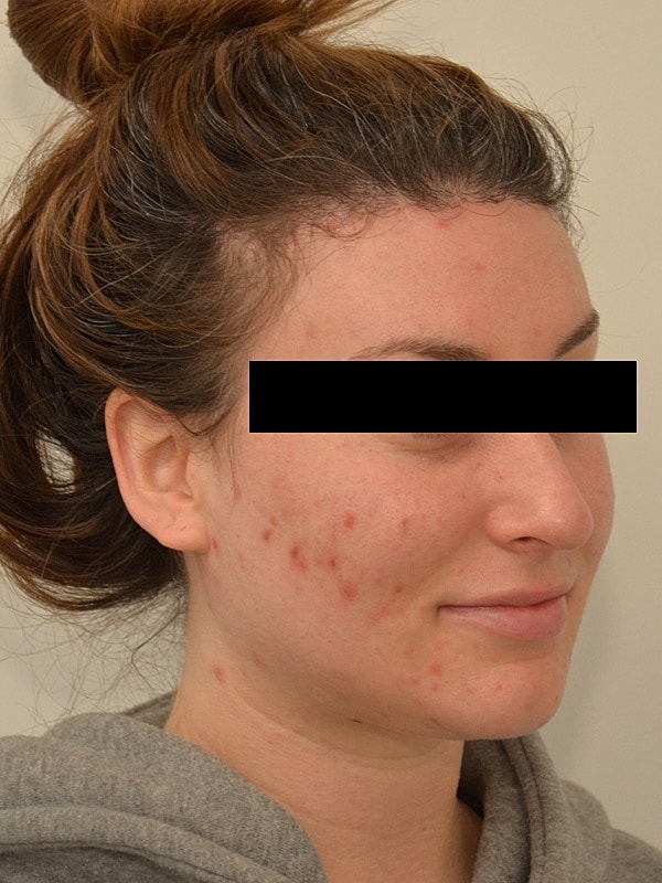 Hairline Lowering Before & After