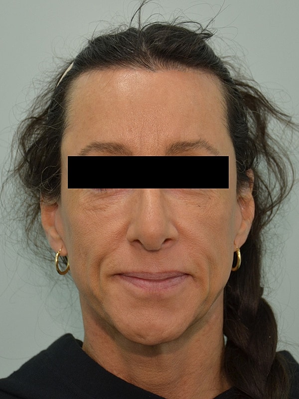 Hairline Lowering Before & After