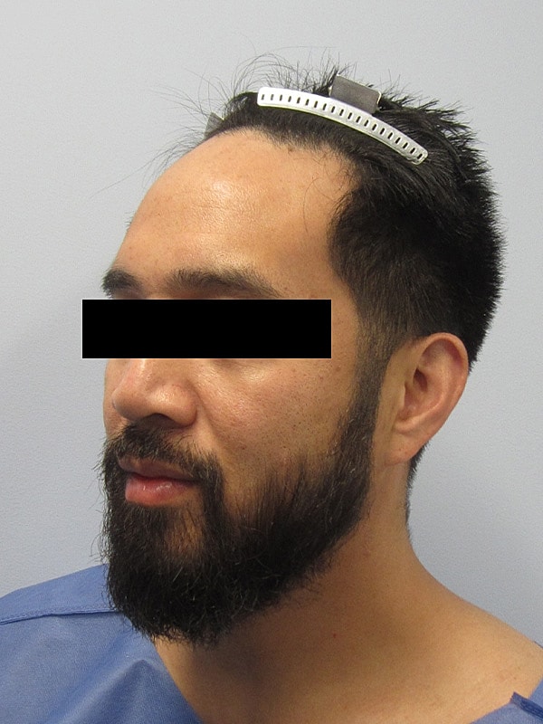 Hairline Lowering Before & After