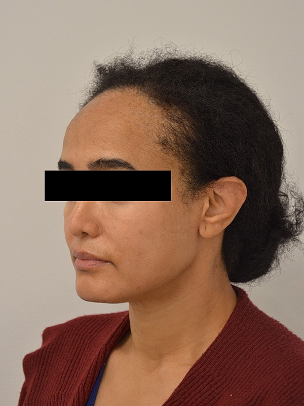 Hairline Lowering Before & After